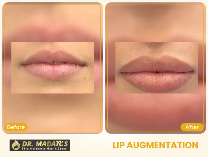 Lip augmentation before and after result 3 at Dr Madan Aesthetics